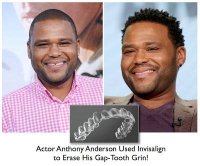 anthony anderson fixed gap teeth